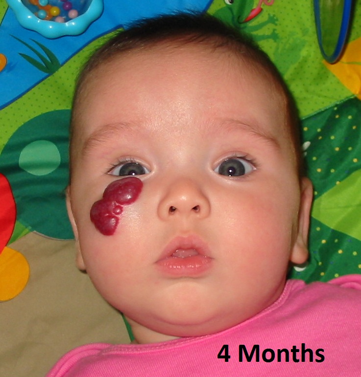 infant hemangioma #10
