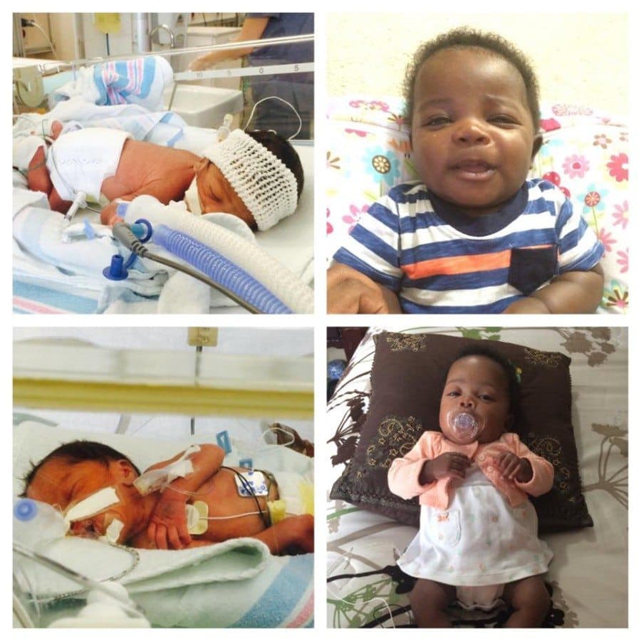 A Beautiful Gallery of Preemie Twins: Before and After ...