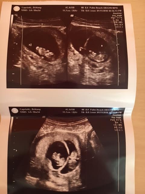 10 week twin pregnancy