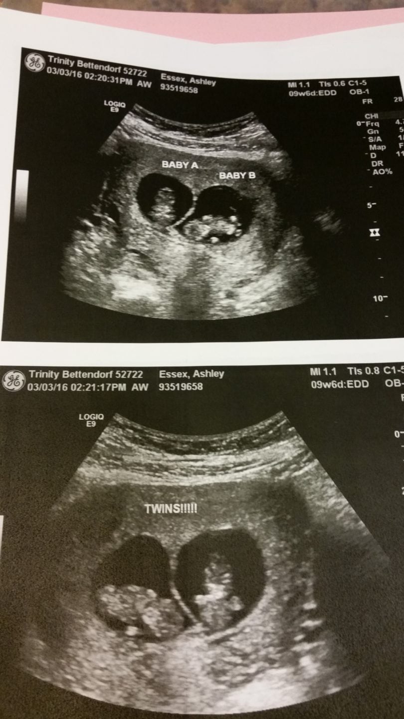 10 weeks of pregnancy ultrasound