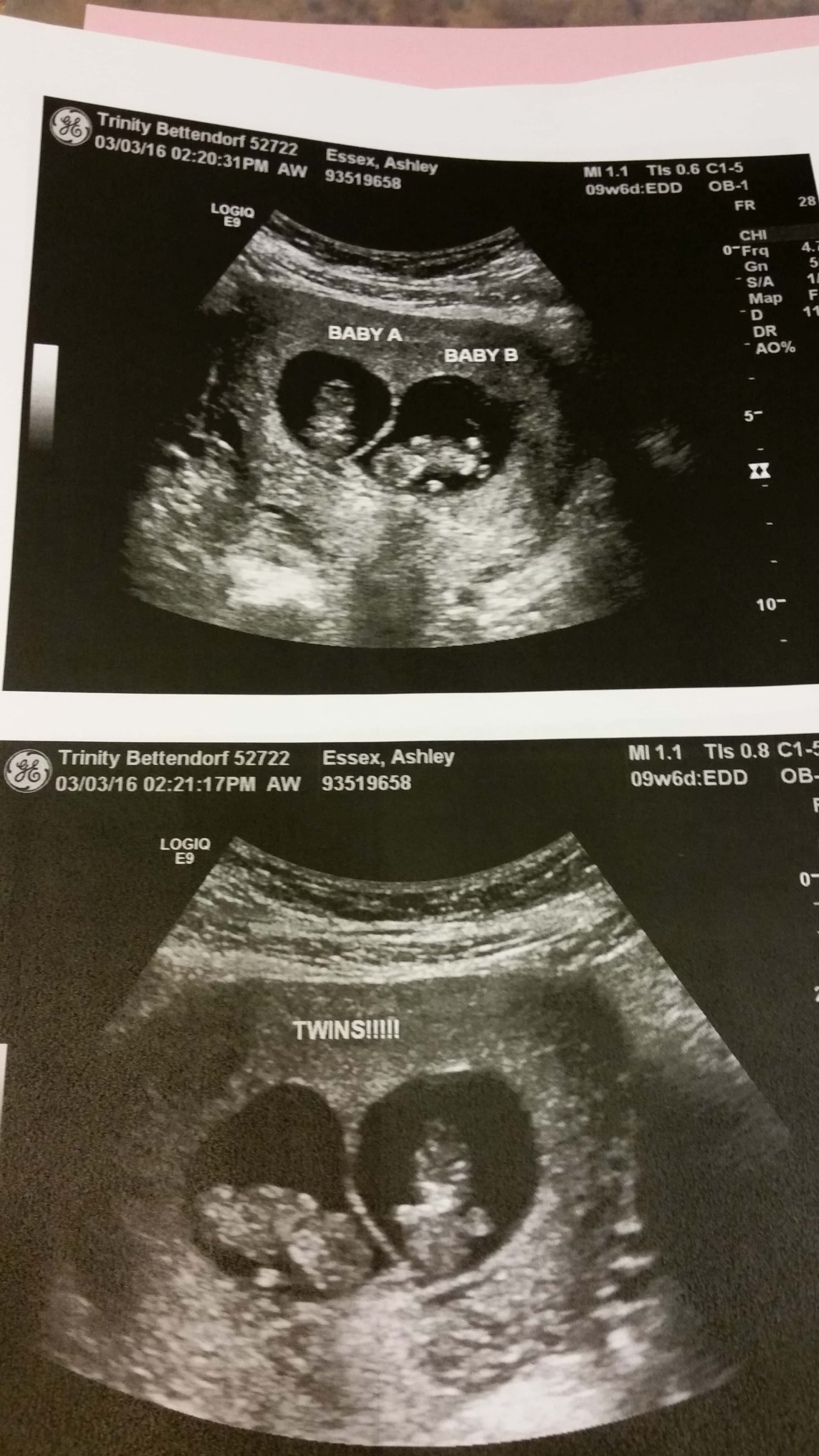 10 week twin ultrasound