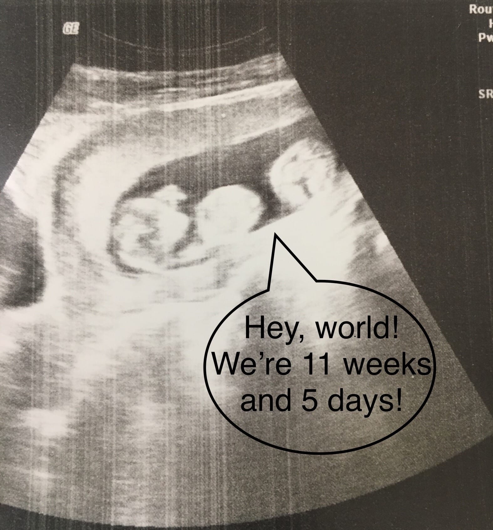 11 weeks pregnant with twins