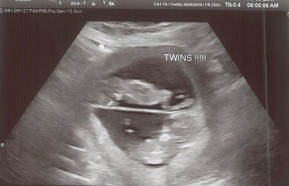 11 weeks pregnant with twins