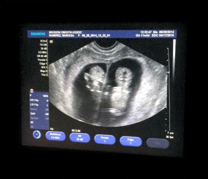 11 weeks pregnant with twins during a normal twin pregnancy