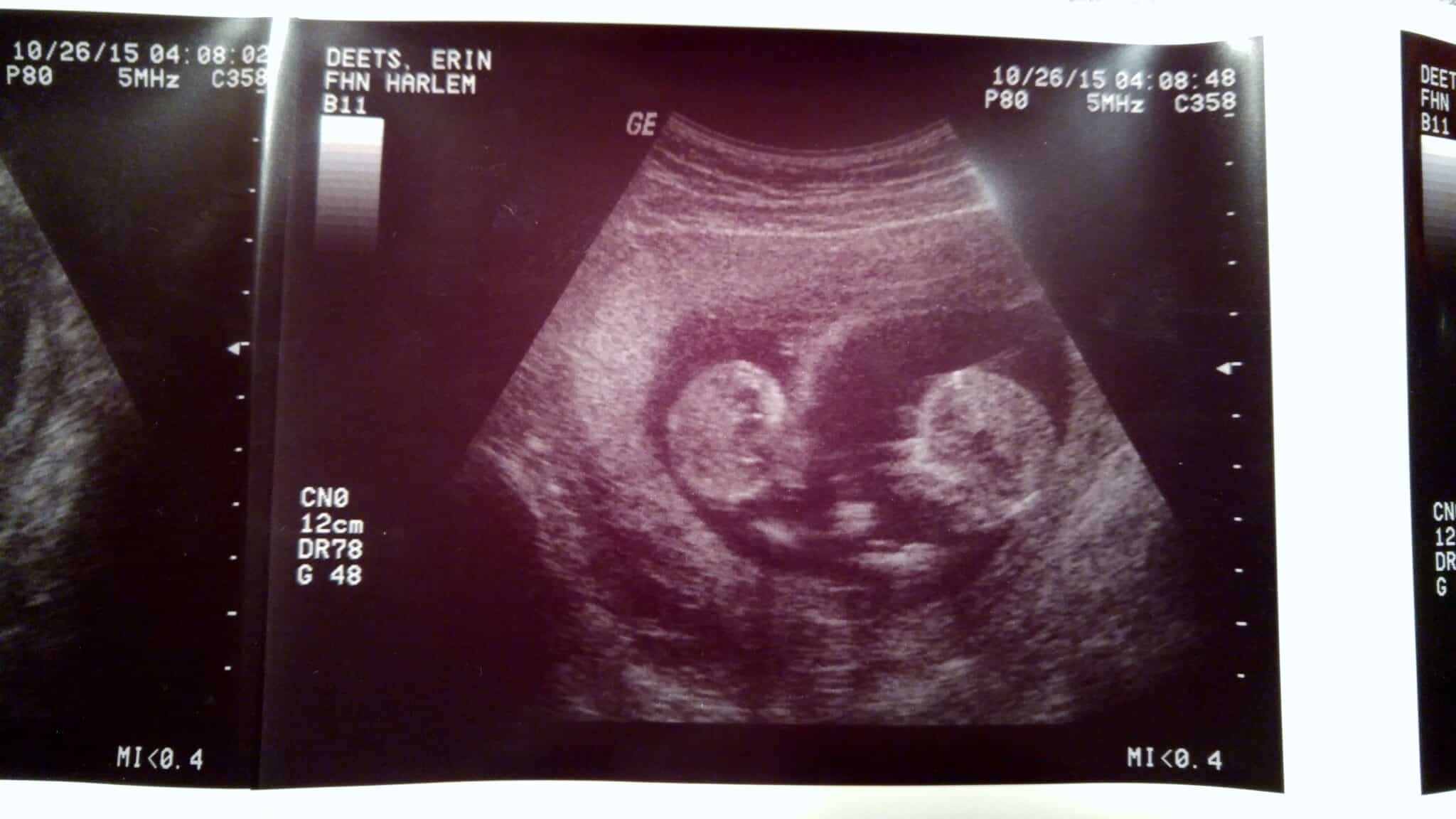 12 Weeks Pregnant with Twins