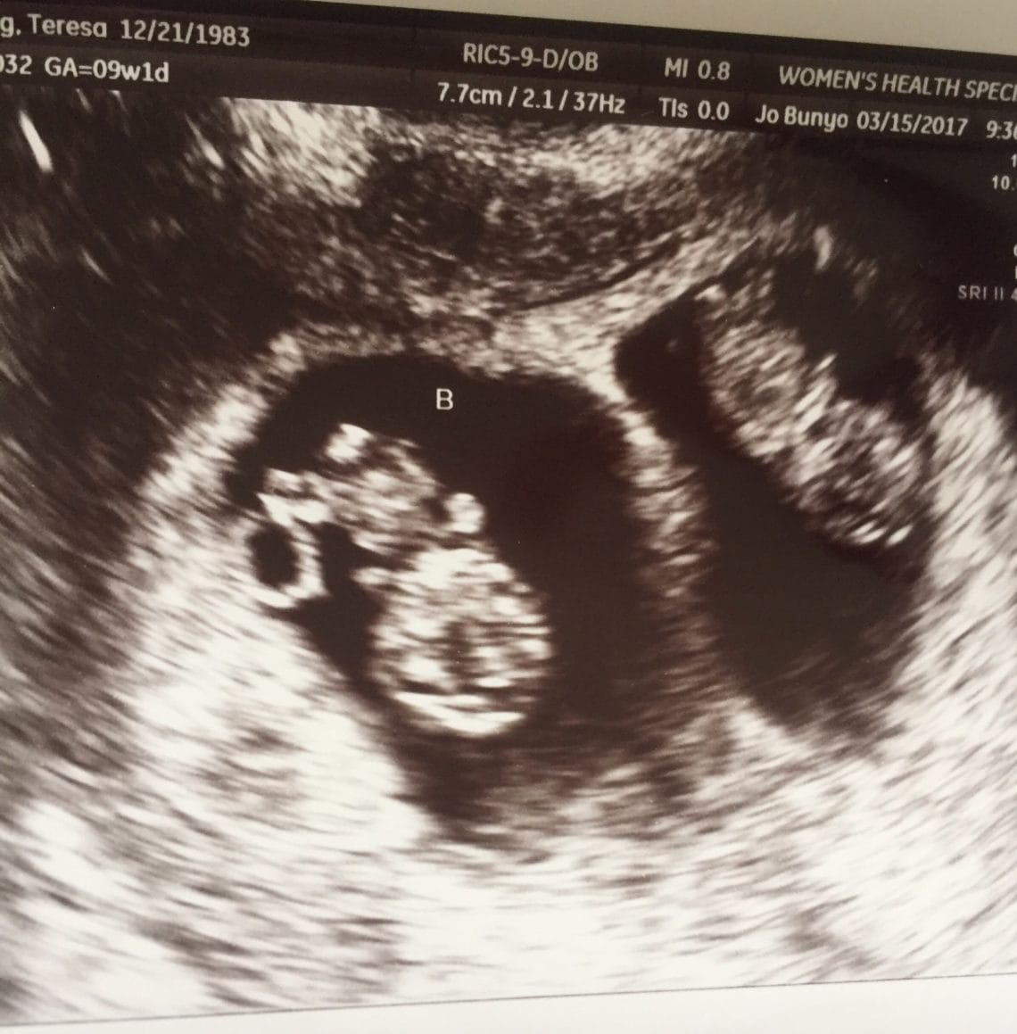 12 week sonogram 12 week sonogram