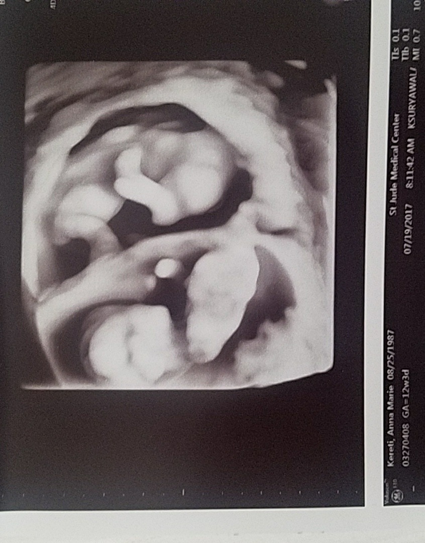 12 Weeks Pregnant with Twins