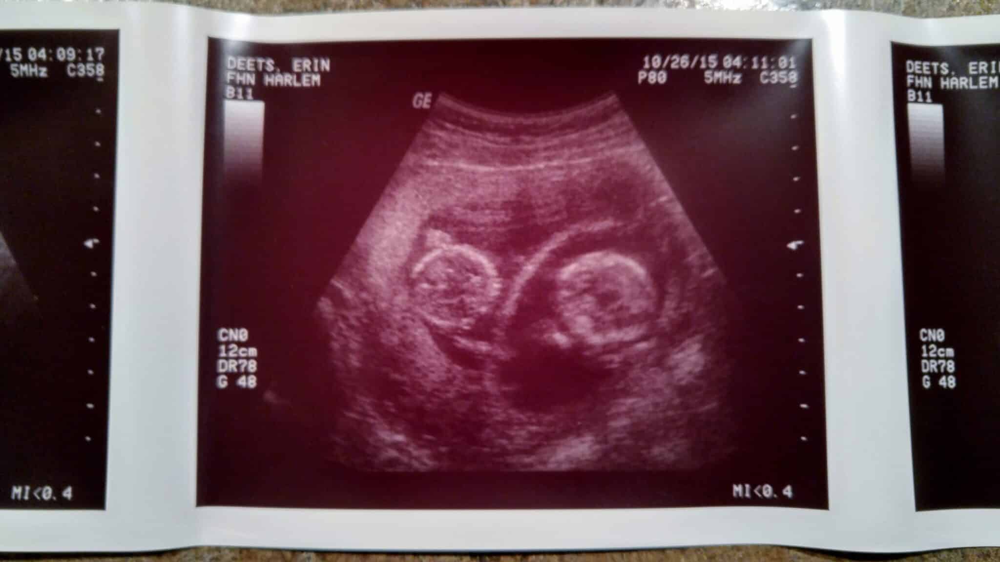 12 Weeks Pregnant with Twins