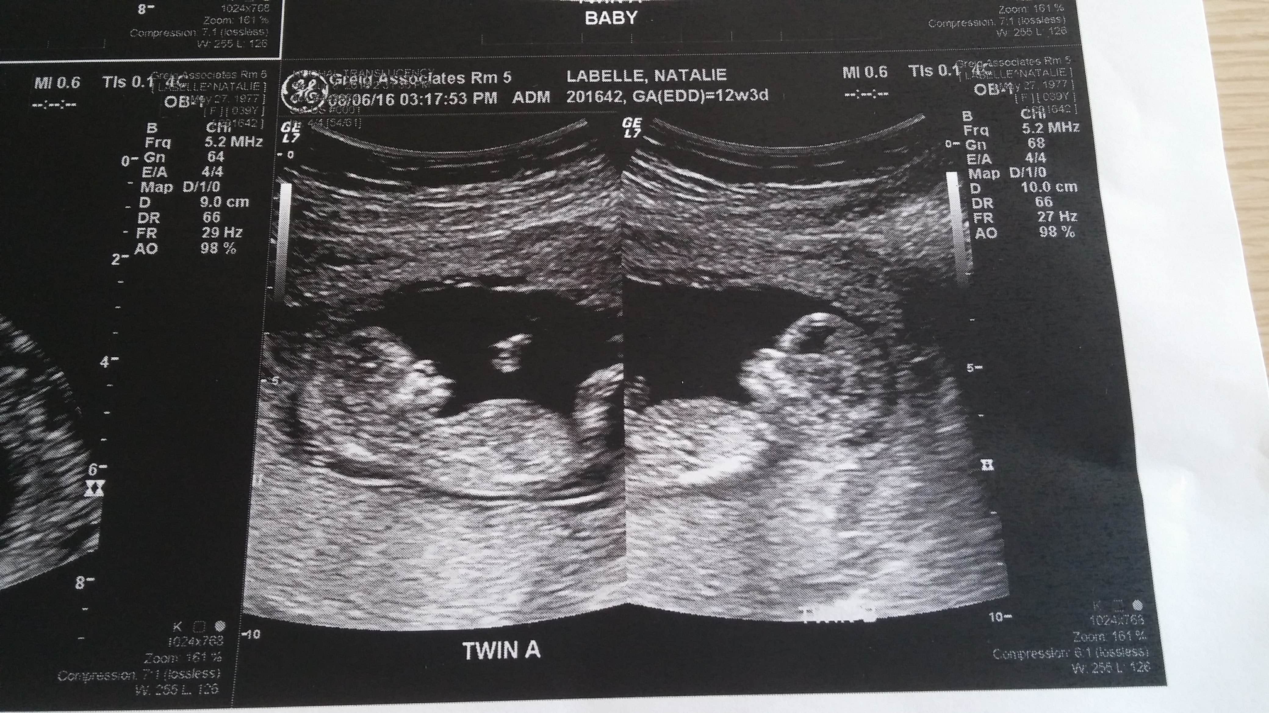 12 Weeks Pregnant with Twins