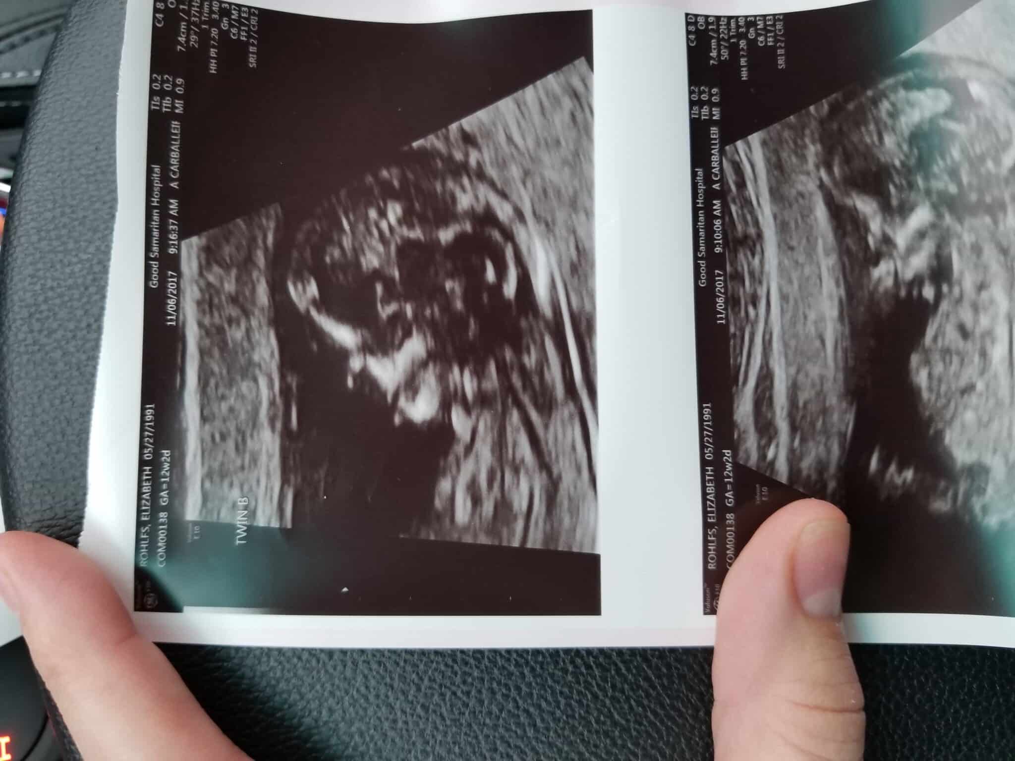 12 weeks ultrasound twin 4D Twins