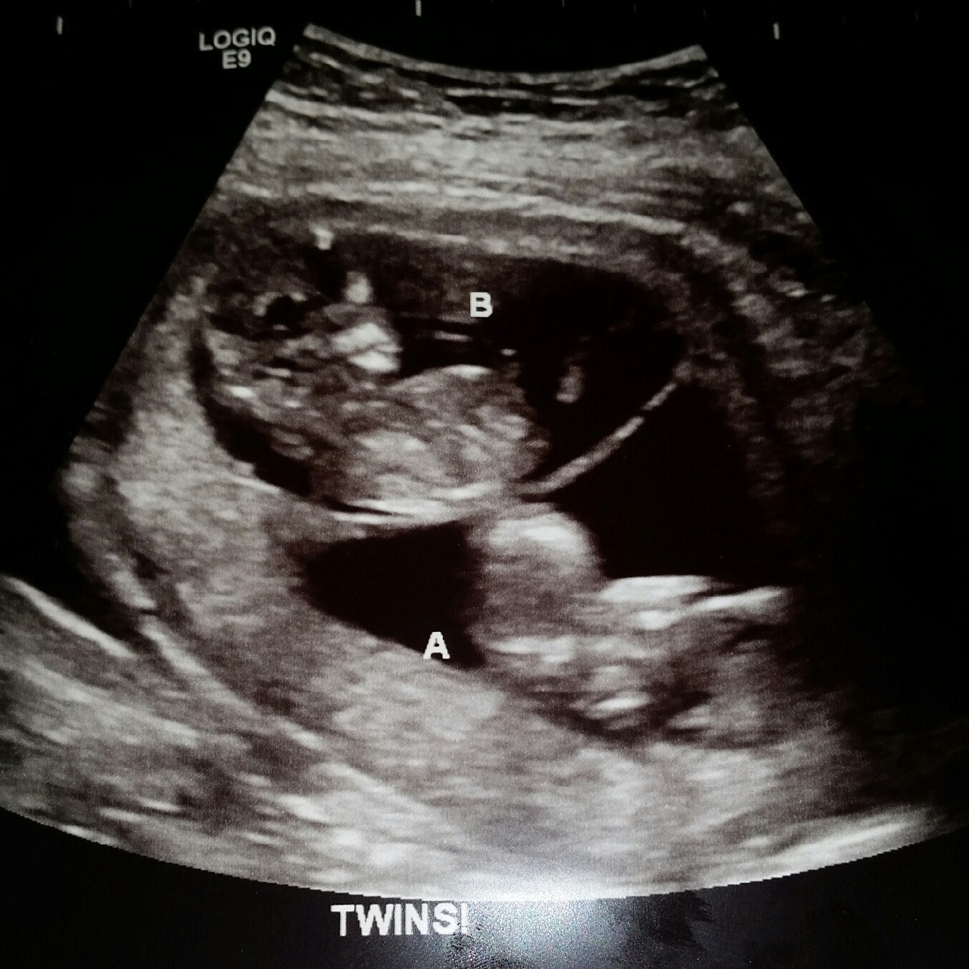 12 Weeks Pregnant with Twins