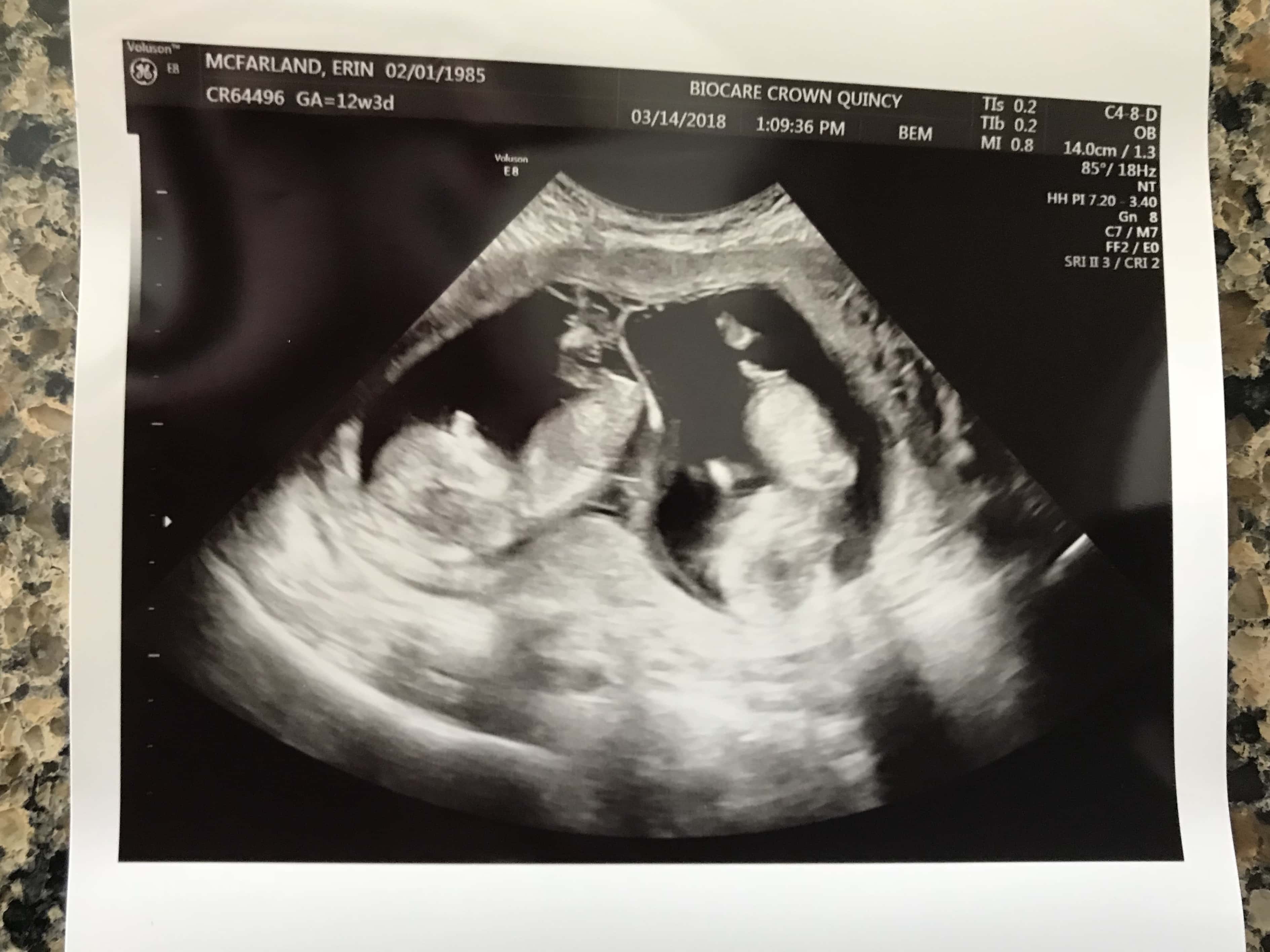 12 Weeks Pregnant Ultrasound Girl