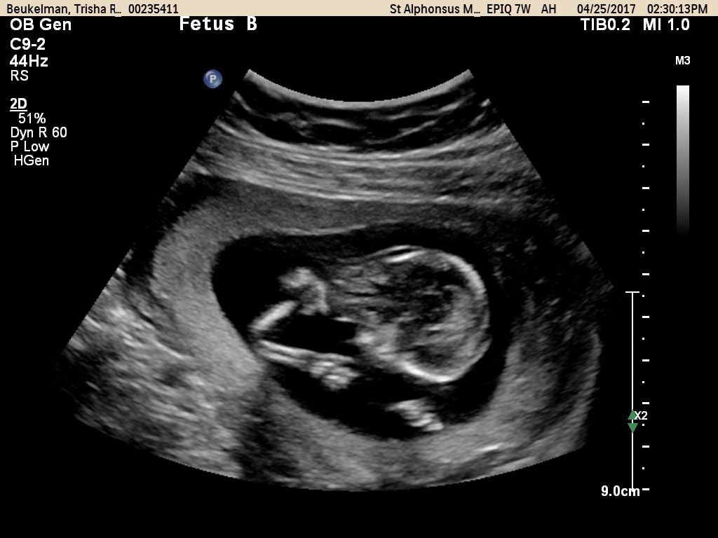 13 weeks pregnant with twins