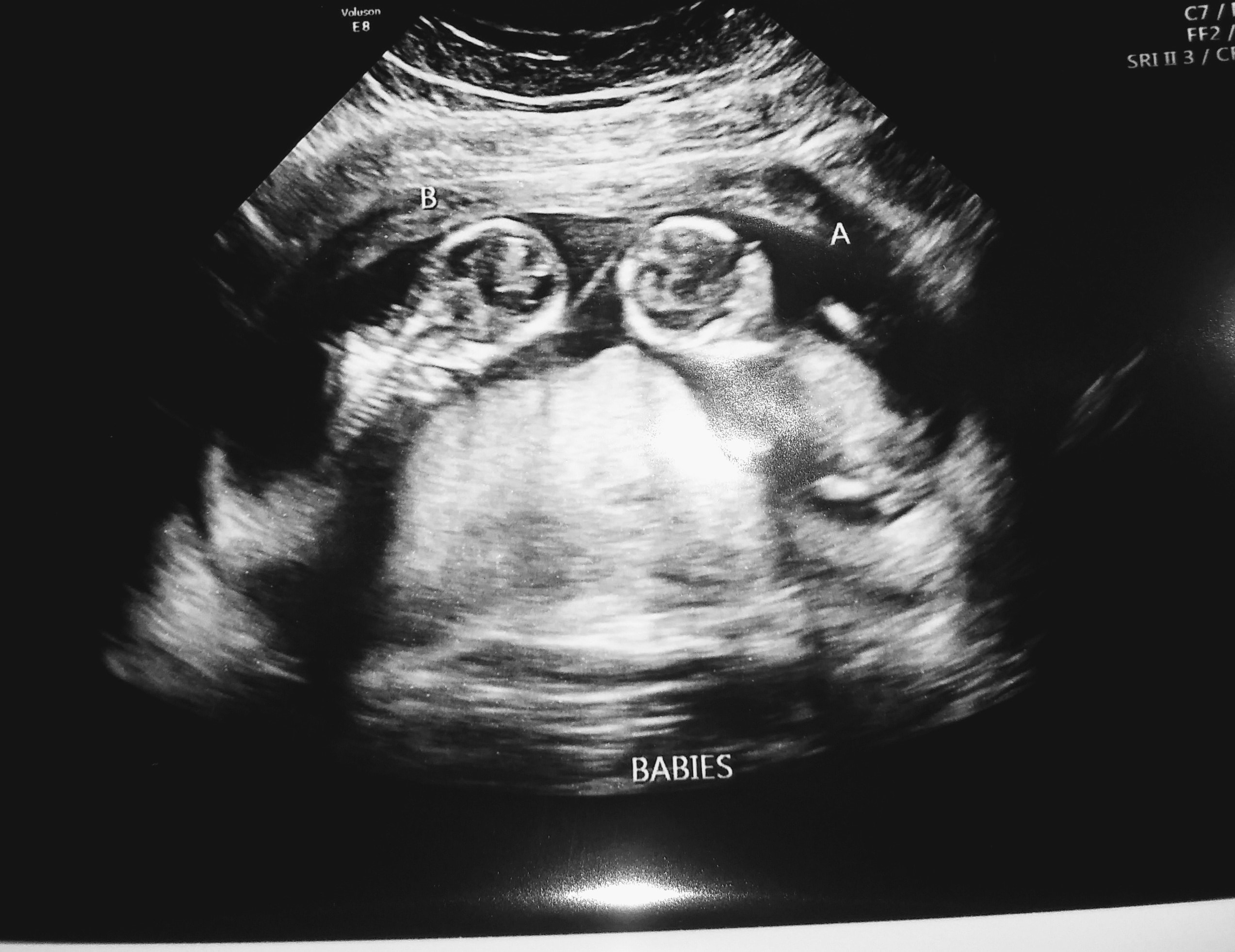 13 Weeks Pregnant Ultrasound Twins