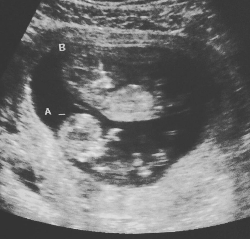 Ultrasound Pictures Of Identical Twins