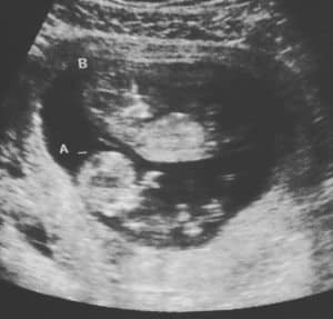 14 weeks pregnant with twins