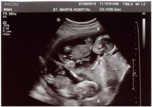 On up when do twins ultrasound show 5 Weeks