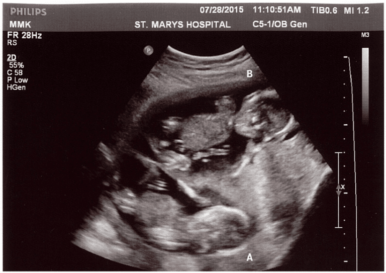 Did You Find Out It Was Twins At Later Ultrasound? Twin Ultrasound