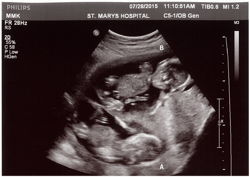 15 weeks pregnant twins ultrasound