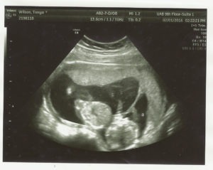 15 weeks pregnant with twins ultrasound