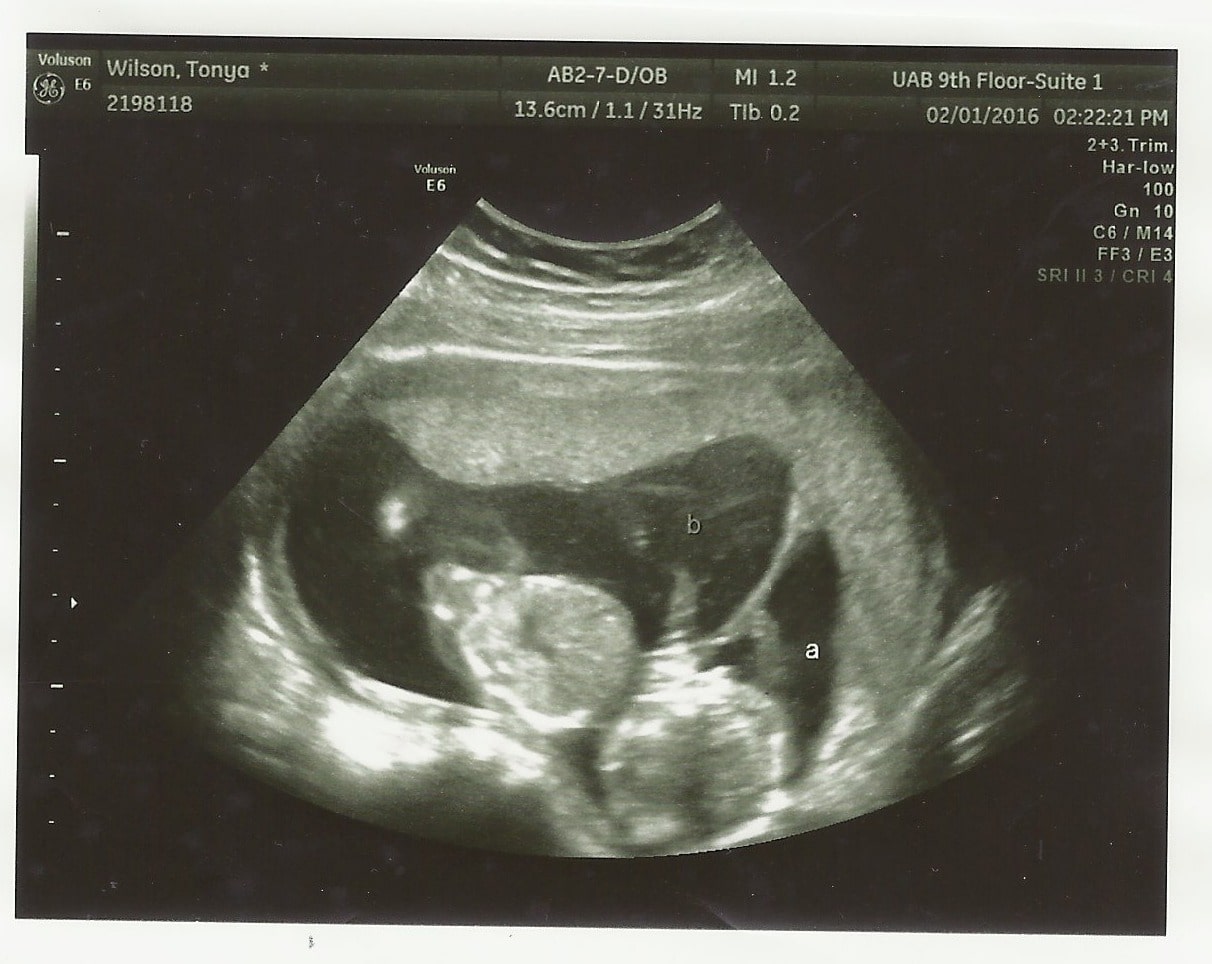 15 weeks ultrasound - Twiniversity