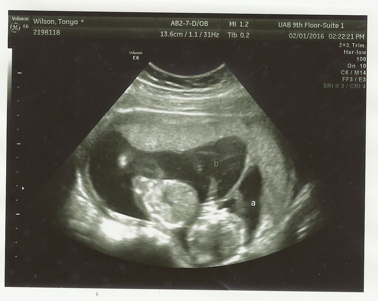 15 weeks pregnant with twins