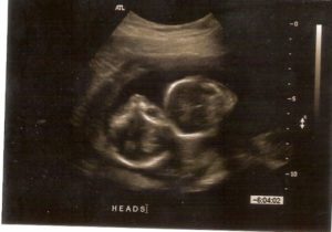 17 weeks twin ultrasound