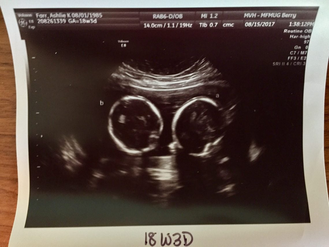 Did You Find Out It Was Twins At Later Ultrasound? Twin Ultrasound