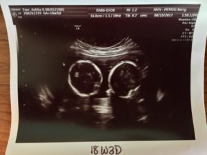 Twin pregnancy missed [Abnormal twin