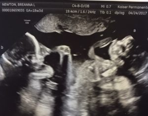 18 weeks twin ultrasound