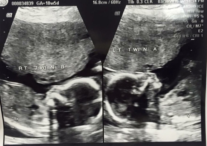 18 weeks pregnant with twins