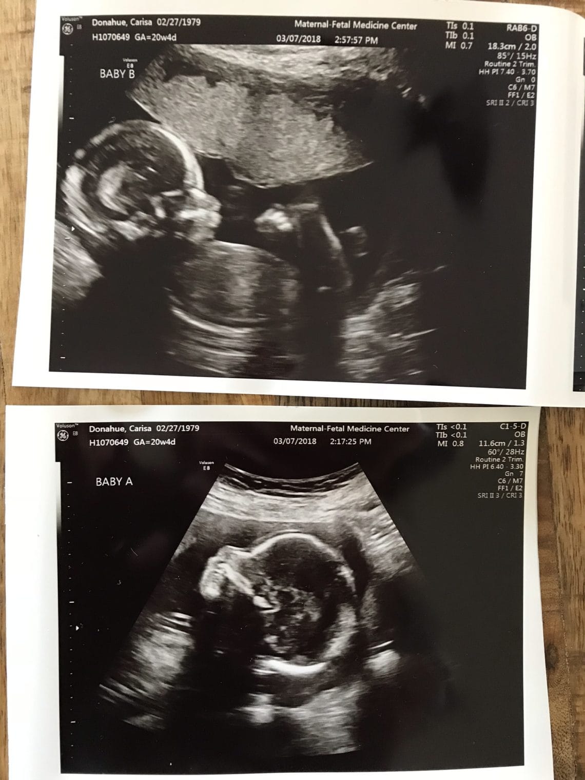16 Week Twin Ultrasound