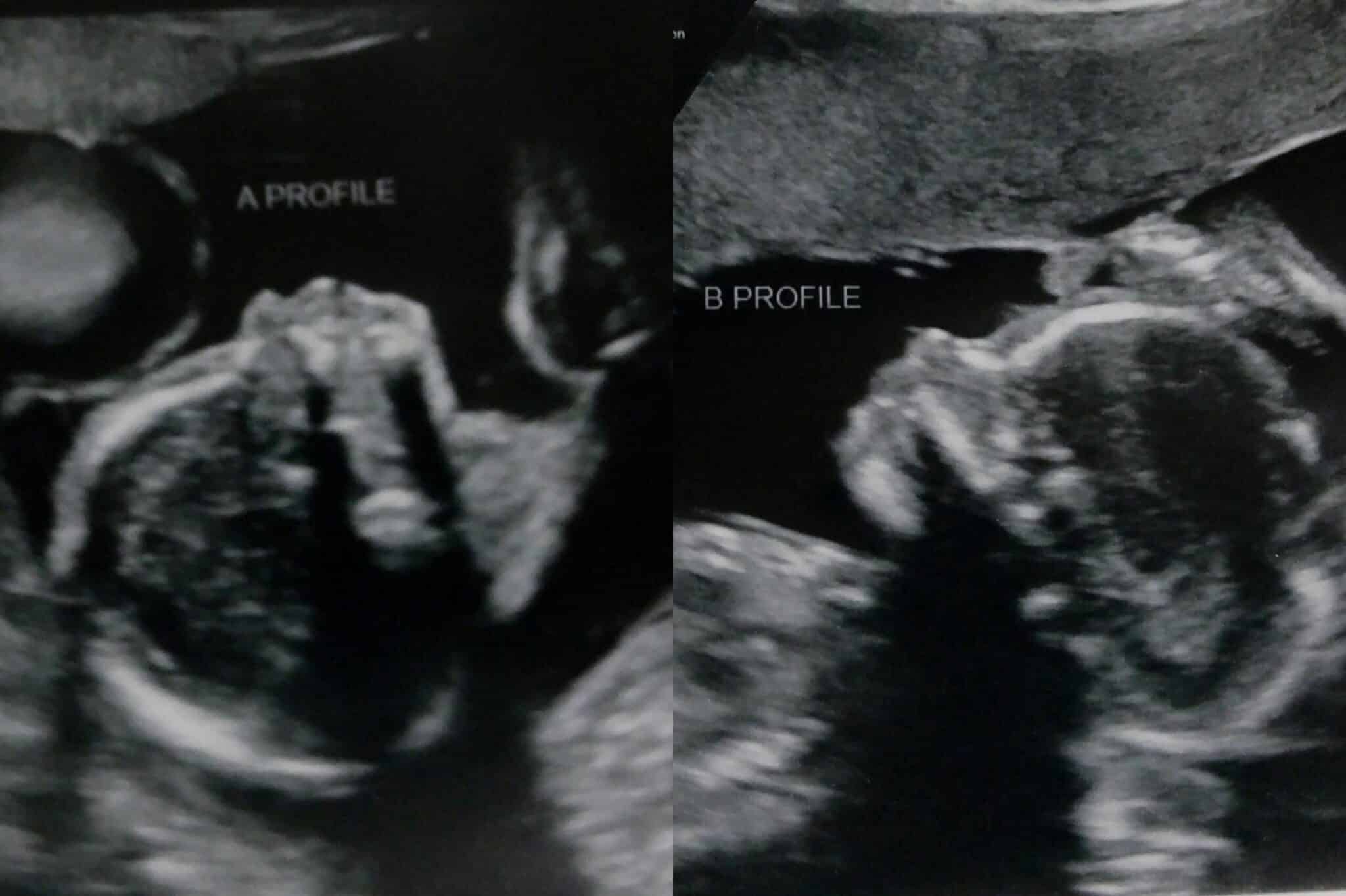 20 weeks pregnant with twins