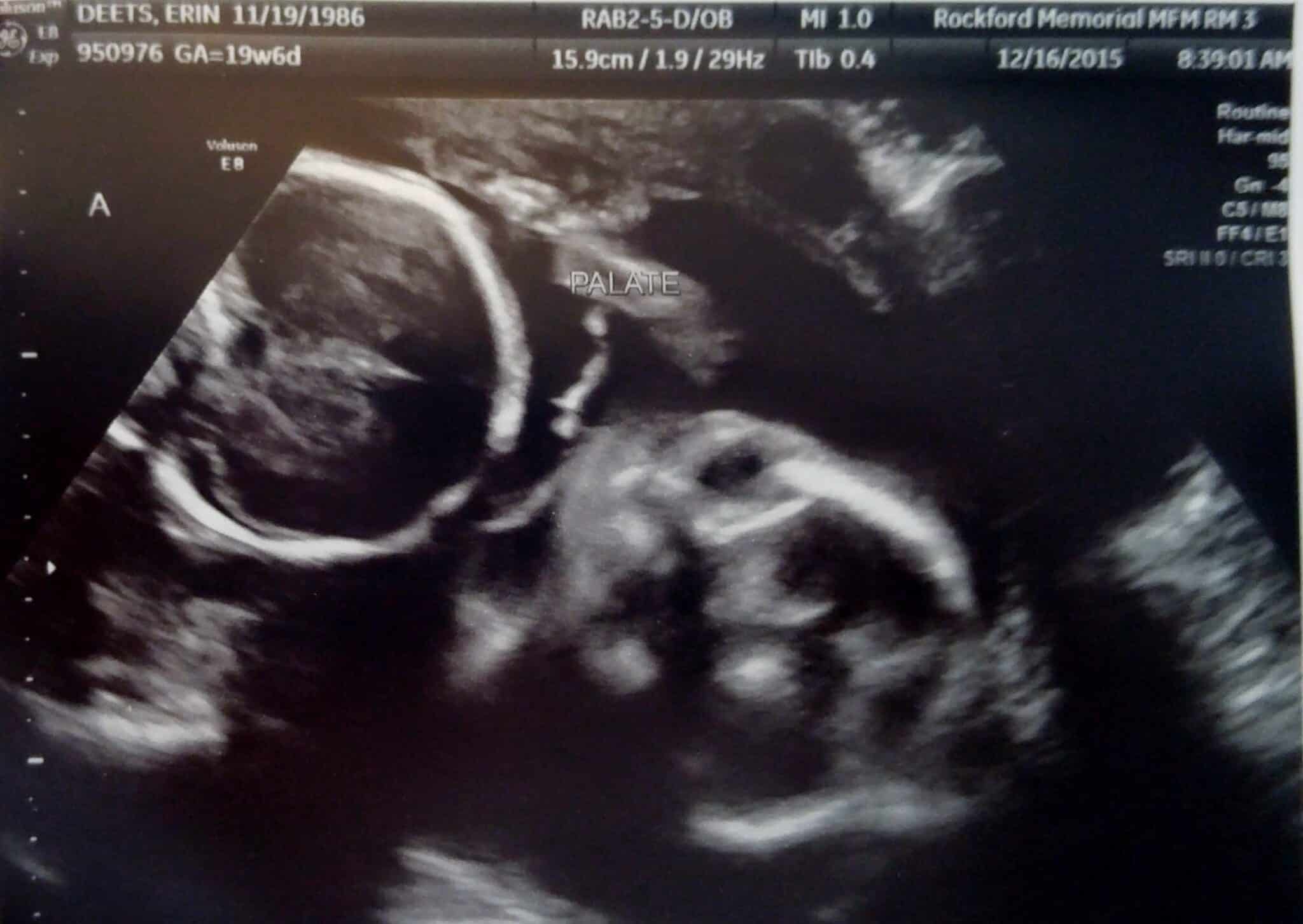 20 weeks pregnant with twins