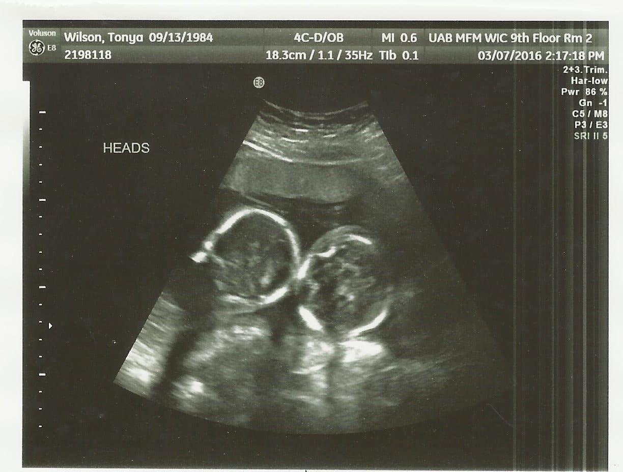 20 Weeks Ultrasound 2 Twiniversity