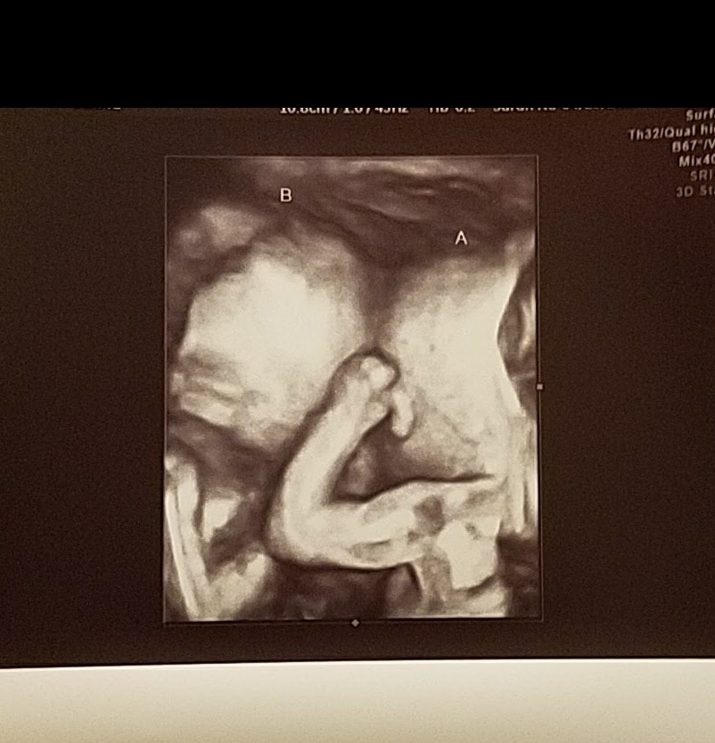 20 weeks pregnant with twins