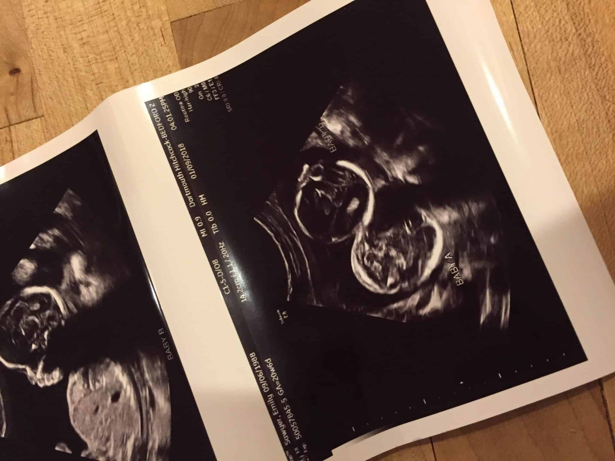 20 weeks pregnant with twins