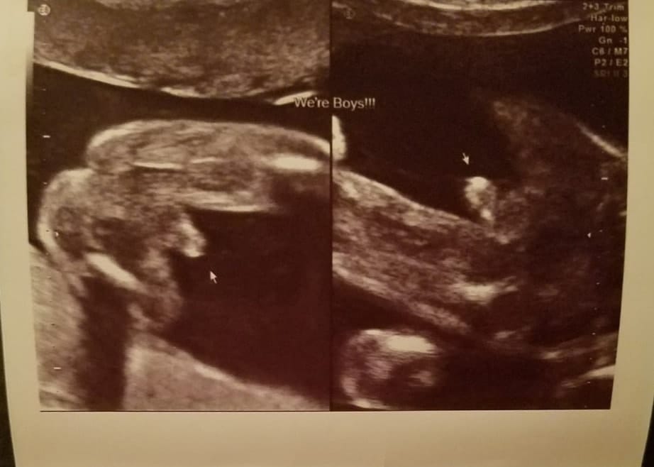 20 weeks pregnant with twins