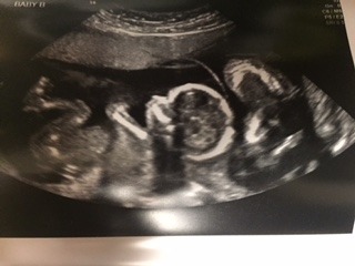 20 weeks pregnant with twins (1)