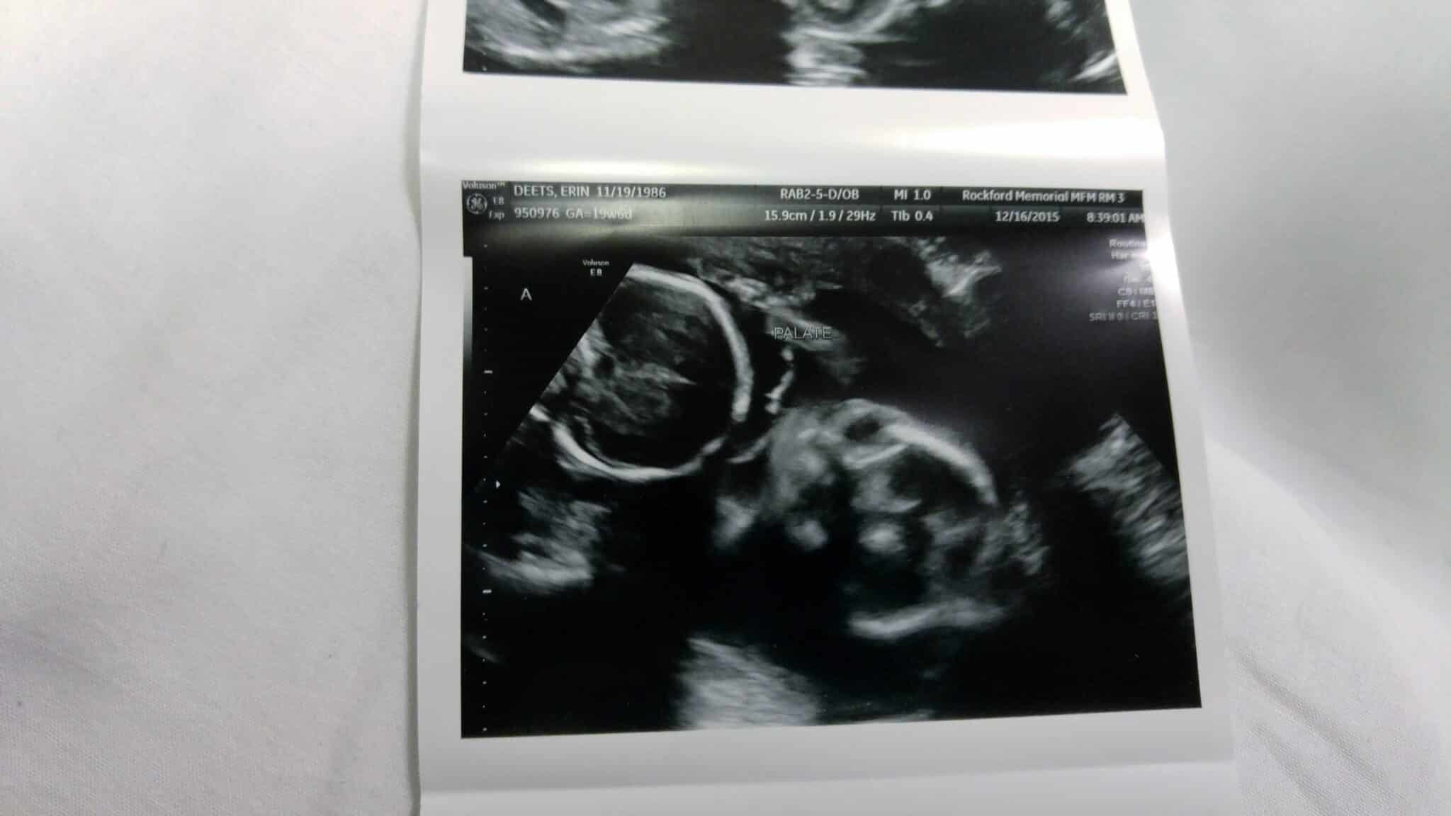20 weeks pregnant with twins (1)