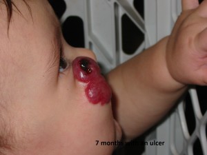Do You Know What a Hemangioma Is?
