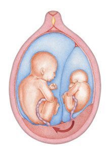 identical twin pregnancy TTTS drawing of womb