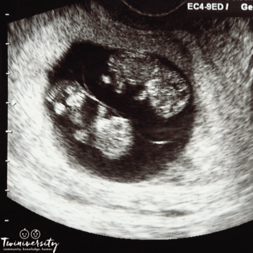 an ultrasound image of identical twins