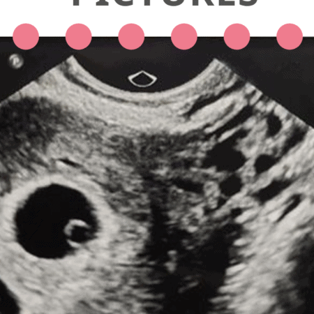 baby ultrasound photo