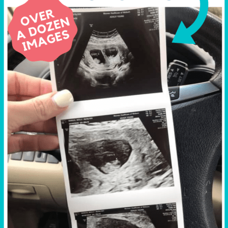 Ultrazvukový snímek dvojčat v 7. týdnu těhotenství