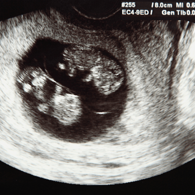 twins ultrasound two fetuses shown on an early ultrasound