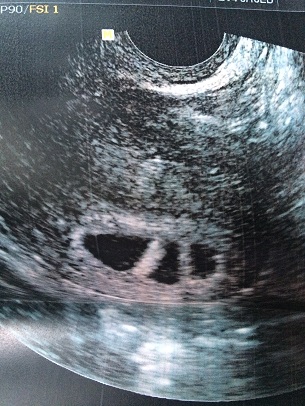 having triplets ultrasound photo early in pregnancy