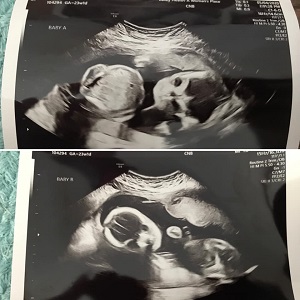 23 Weeks Pregnant With Twins Ultrasound