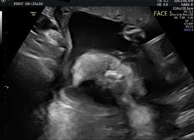 双子妊娠23週