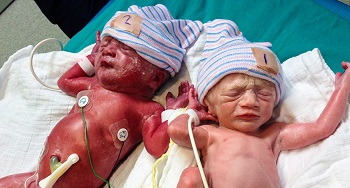 Newborns with TAPS in hospital hats with wires and monitors